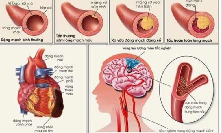 Xơ vữa động mạch làm gia tăng nguy cơ nhồi máu cơ tim, tai biến mạch máu não