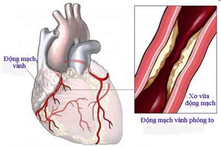 Xơ vữa động mạch là nguyên nhân hàng đầu gây bệnh mạch vành