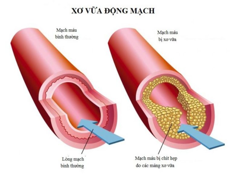 Xơ vữa động mạch có thể được điều trị bằng thuốc hoặc can thiệp ngoại khoa