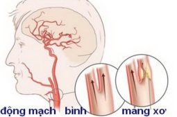 Động mạch cảnh có nhiệm vụ cung cấp máu giàu oxy và dưỡng chất từ tim lên não, rất dễ bị xơ vữa theo thời gian