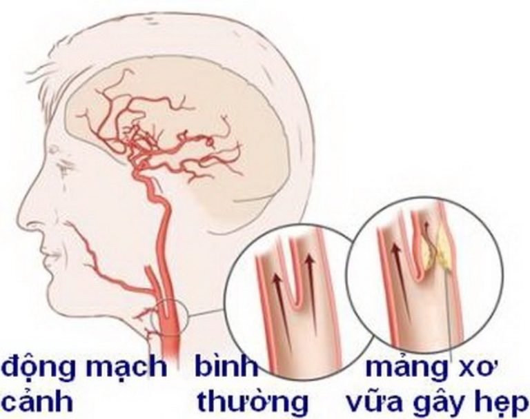 Động mạch cảnh có nhiệm vụ cung cấp máu giàu oxy và dưỡng chất từ tim lên não, rất dễ bị xơ vữa theo thời gian