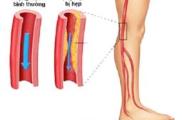 Xơ vữa động mạch chi dưới là tình trạng lòng động mạch bị tích tụ chất béo, cholesterol, canxi, tế bào viêm và các chất khác trong máu