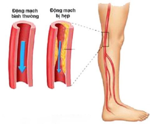 Xơ vữa động mạch chi dưới là tình trạng lòng động mạch bị tích tụ chất béo, cholesterol, canxi, tế bào viêm và các chất khác trong máu