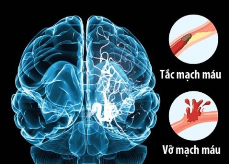 Xơ vữa động mạch não là một trong những nguyên nhân hàng đầu gây đột quỵ não