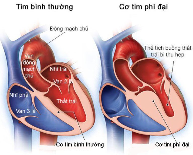 Cơ tim phì đại làm giảm thể tích của buồng thất trái, ảnh hưởng nghiêm trọng đến chức năng tim