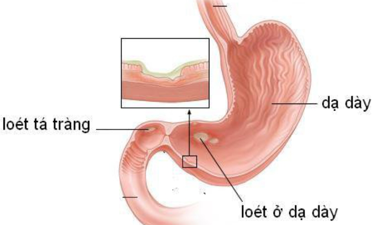 Nguyên tắc điều trị viêm loét dạ dày