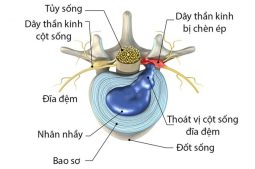 Bệnh thoát vị đĩa đệm