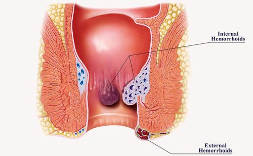 Bệnh trĩ nội