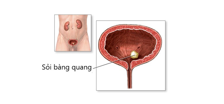 bị sỏi bàng quang nên ăn gì