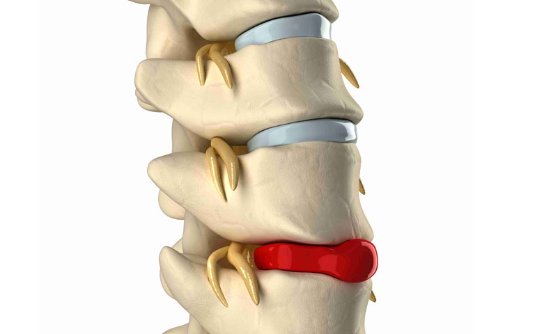 các giai đoạn của bệnh thoát vị đĩa đệm