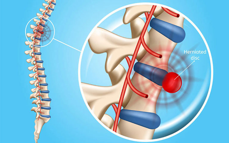 chẩn đoán giai đoạn thoát vị đĩa đệm