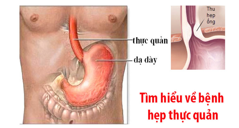 hẹp thực quản là gì