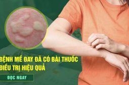Bài thuốc chữa mề đay Thuốc Dân Tộc - Giải pháp "vàng" cho bệnh nhân mề đay mẩn ngứa