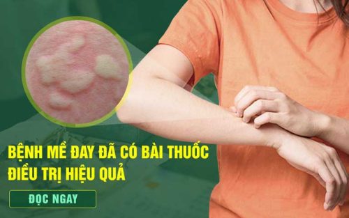 Bài thuốc chữa mề đay Thuốc Dân Tộc - Giải pháp "vàng" cho bệnh nhân mề đay mẩn ngứa