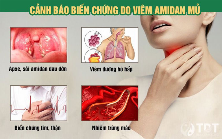 Viêm amidan mủ