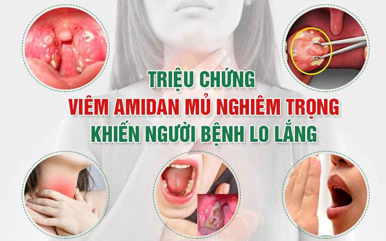 lập kế hoạch chăm sóc trẻ bị viêm amidan mủ 