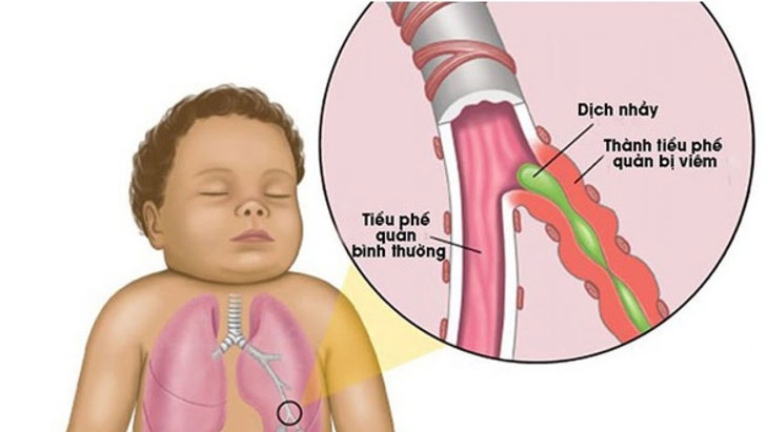 Viêm tiểu phế quản là gì?