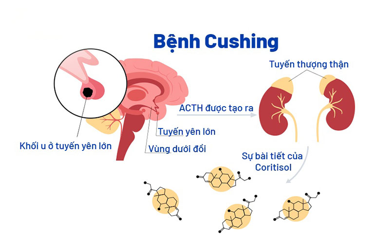 Nguyên nhân gây hội chứng cushing