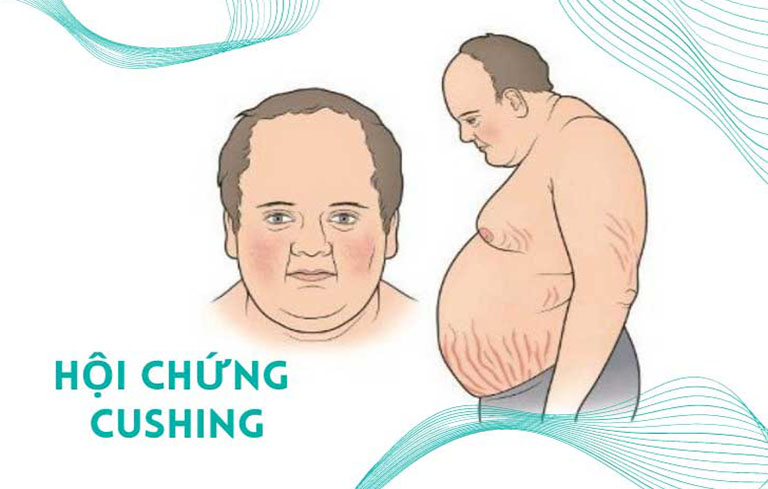 Hội chứng cushing