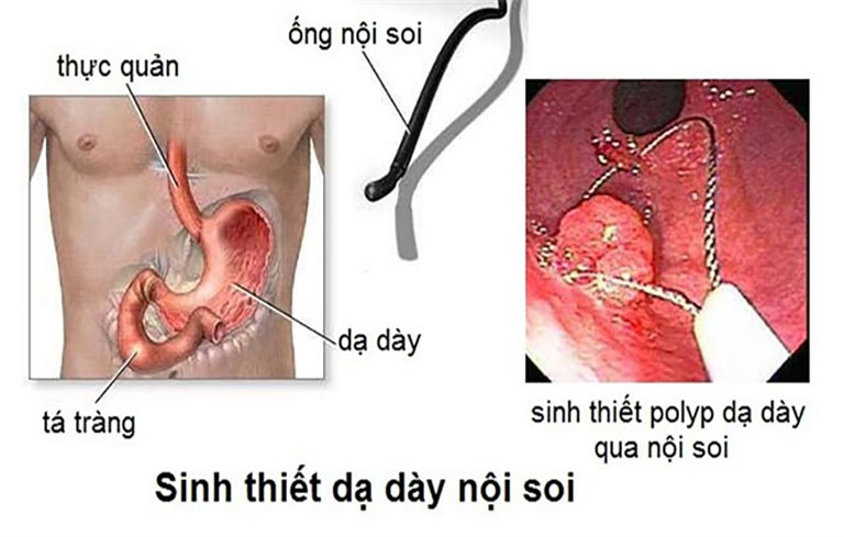 Nội soi và sinh thiết thực quản là 2 phương pháp chẩn đoán hiệu quả đối với tình trạng này