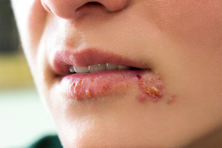 bệnh herpes miệng