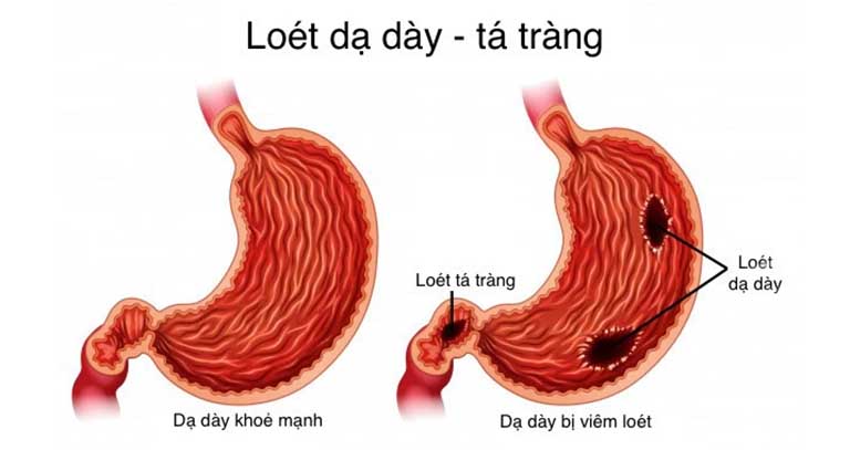 viêm loét dạ dày