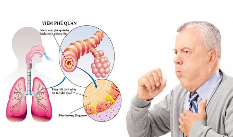 Vì sao rau diếp cá chữa trị được bệnh viêm phế quản?