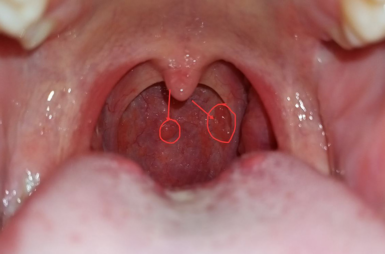 Tìm hiểu bệnh viêm họng hạt có nguy hiểm không