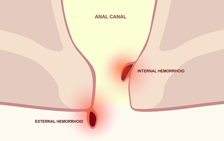 Bệnh trĩ ở phụ nữ sau sinh