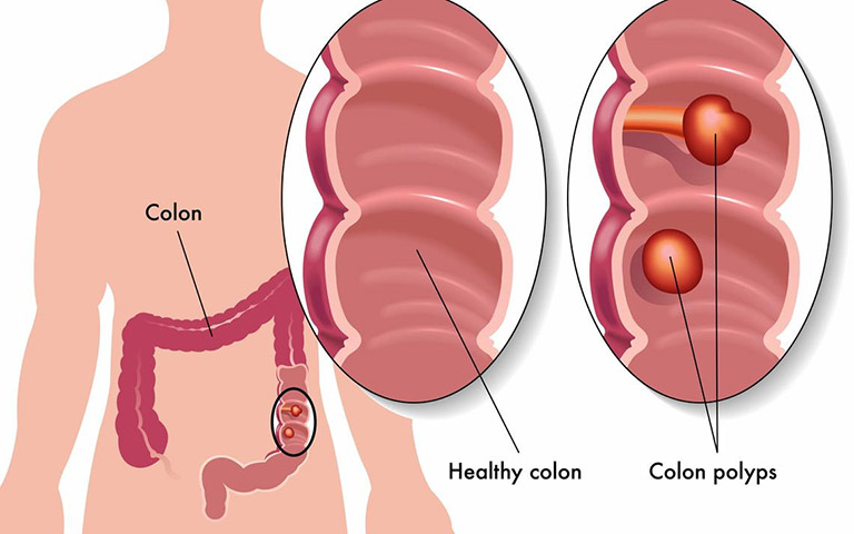 Hình ảnh đại tràng khỏe mạnh và đại tràng có polyp