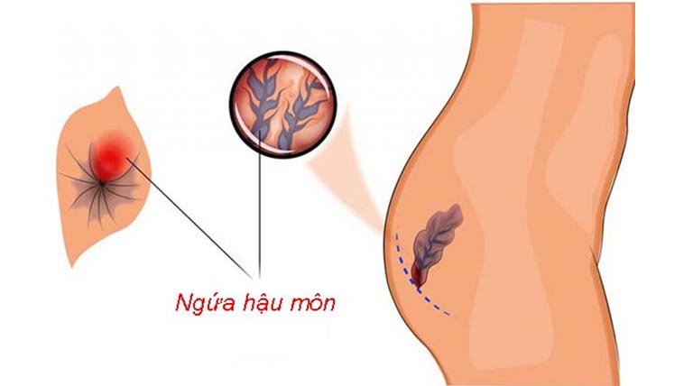 Viêm ngứa hậu môn