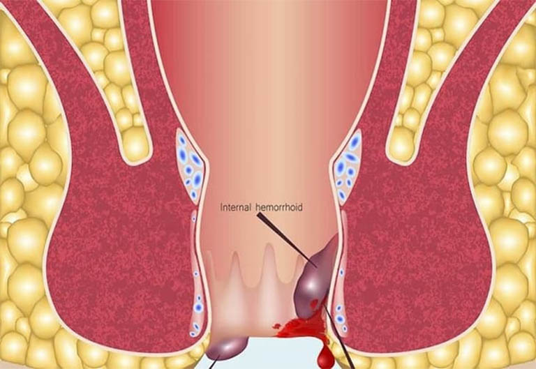 Bệnh trĩ huyết khối là gì