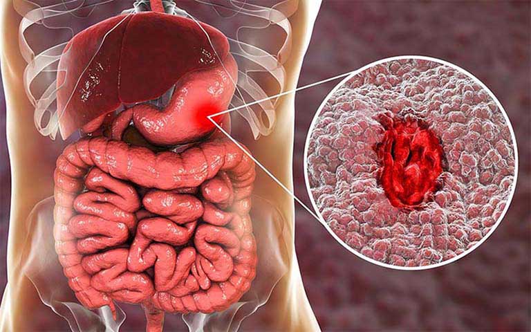 Cách trị đi cầu ra máu tại nhà