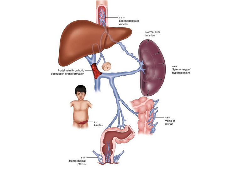Chữa tăng áp lực tĩnh mạch cửa