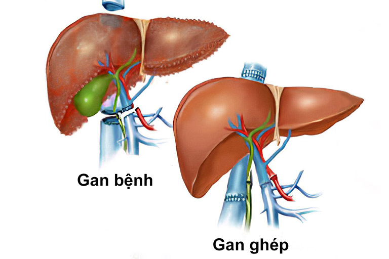 Điều trị hội chứng gan - thận ở bệnh nhân xơ gan bằng phương pháp ghép gan