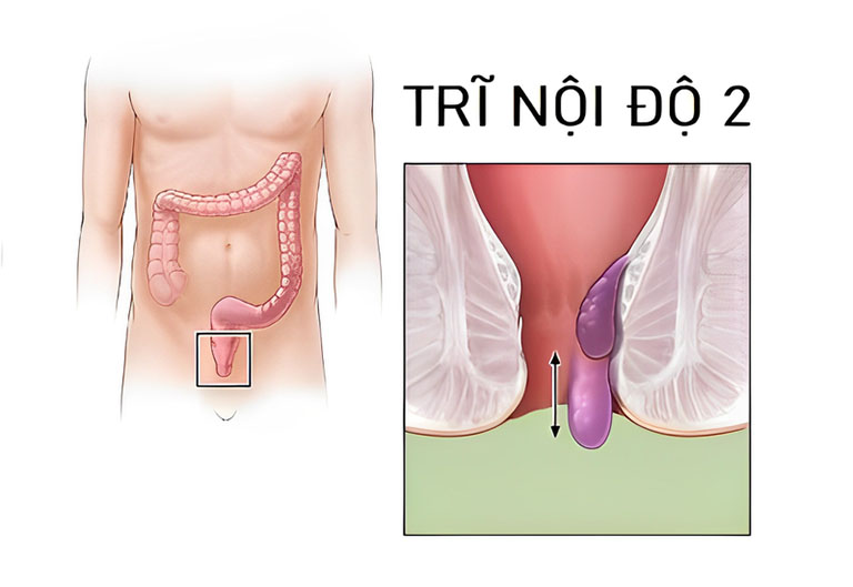 Bệnh trĩ nội độ 2