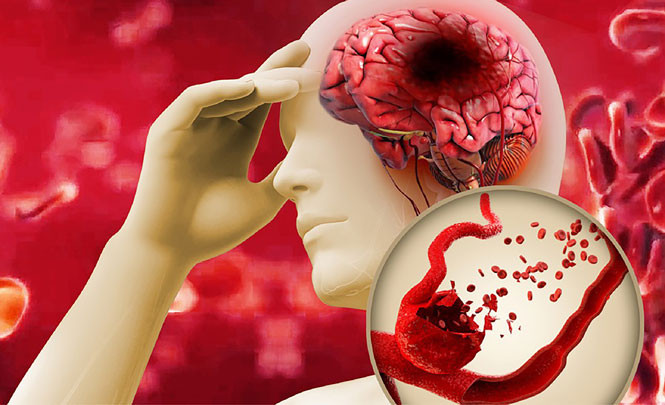 Đột quỵ não là biến chứng nguy hiểm do mỡ máu cao