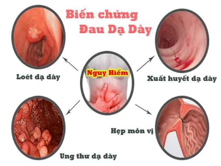 Các biến chứng nguy hiểm có thể xảy ra nếu tình trạng đau dạ dày kéo dài