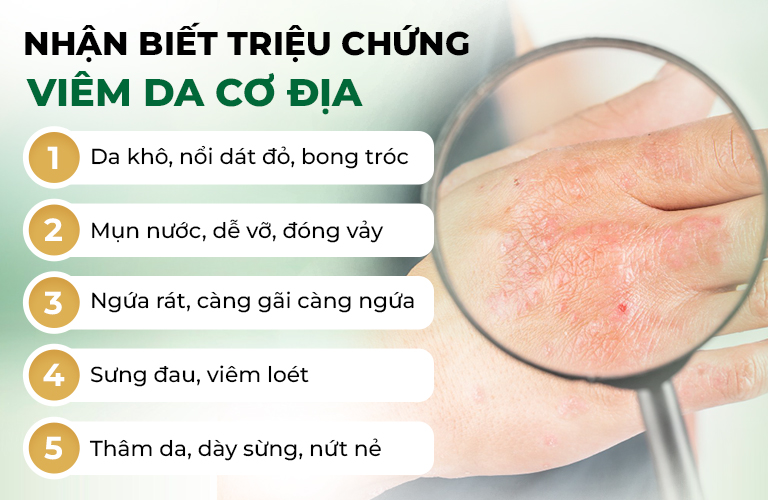 Triệu chứng viêm da cơ địa thường gặp