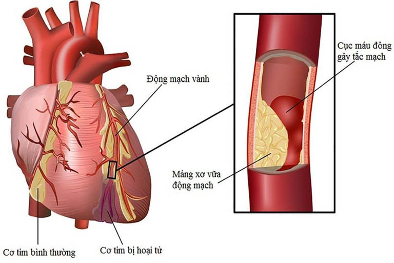 Nhồi máu cơ tim thành dưới là gì