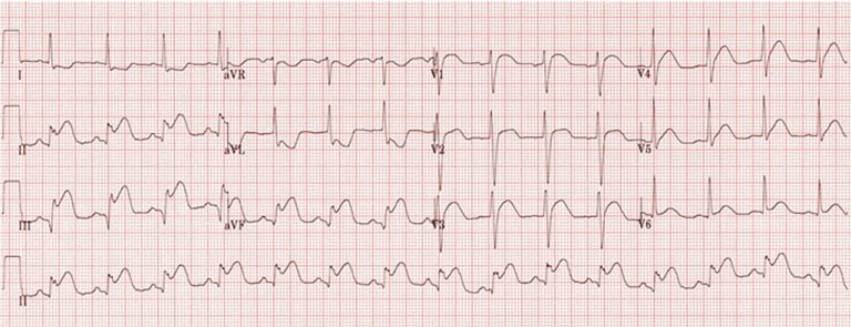 Chẩn đoán nhồi máu cơ tim thành dưới bằng điện tâm đồ