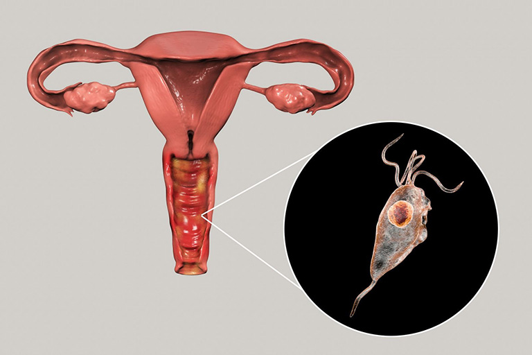 Viêm âm đạo do Trichomonas vaginalis