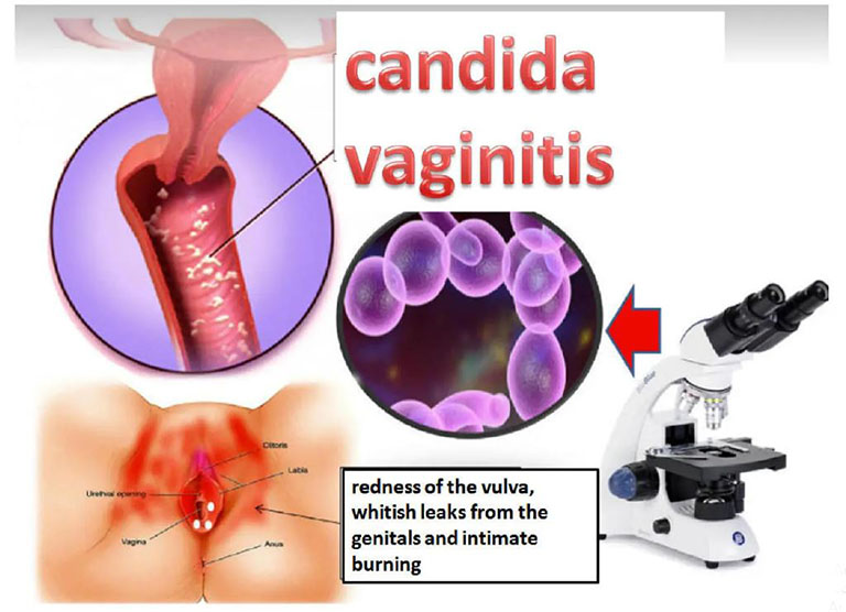 Viêm âm đạo do nấm