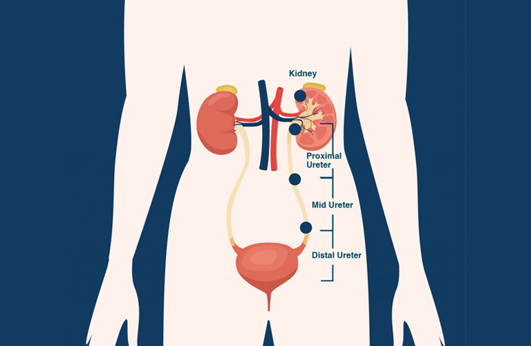 Sỏi niệu quản 1/3 giữa