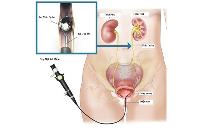 Tán sỏi nội soi ngược dòng