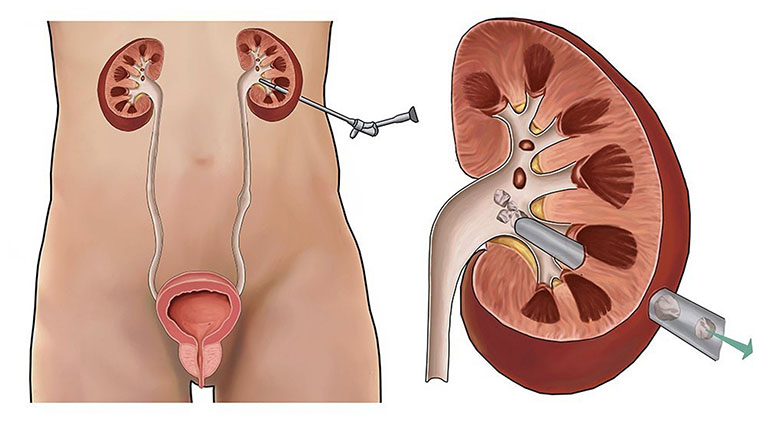 Tán sỏi qua da