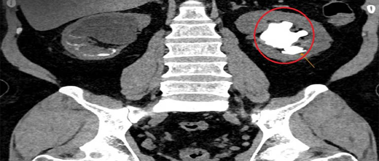 Chẩn đoán hình ảnh sỏi san hô trong thận