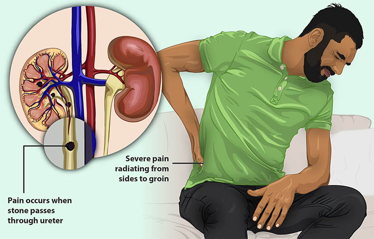 Đau âm ỉ hoặc dữ dội như dao đâm ở vùng mạng sườn thắt lưng