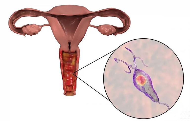 Bệnh viêm âm đạo do trùng roi