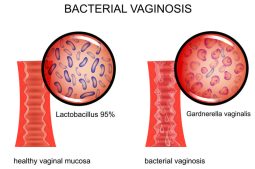 Viêm âm đạo do vi khuẩn